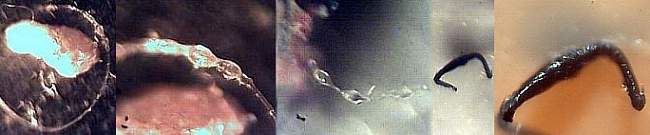 Morgellons bacterial fungal chains