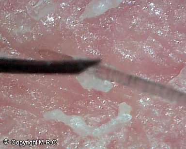 Morgellons after DSP treatment