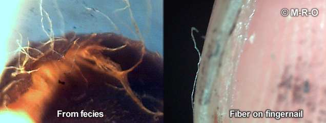 Morgelllons fibers in stool