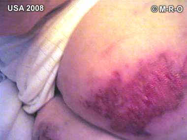 morgellons open wounds