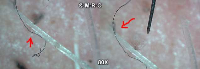 morgellons crawling sensation caused from fibers