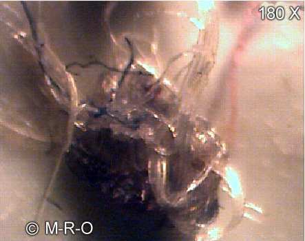 morgellons-fiberbus details