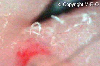morgellons-fibers