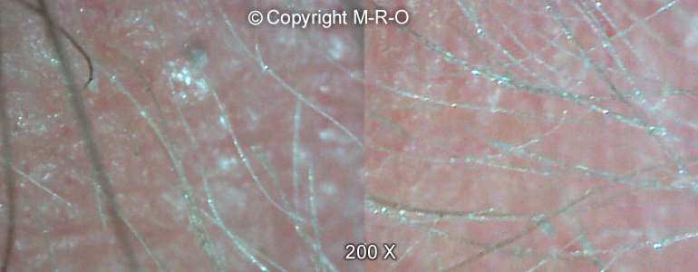 morgellons-hairs