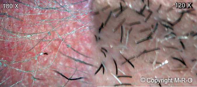 morgellons-hairs