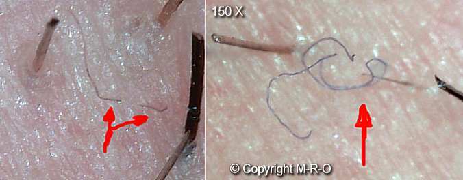 Morgellons-infezione