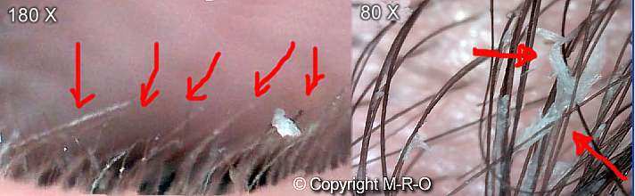 morgellons-infection