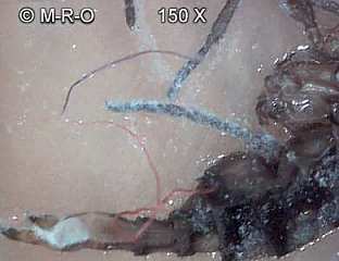 morgellons-insects