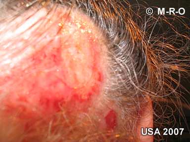 morgellons-lesions