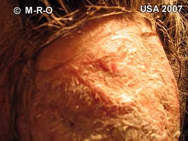 morgellons-lesions