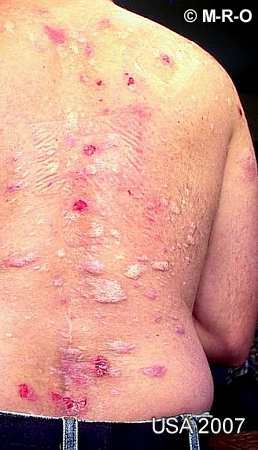 Scabies: Treatment and Scabies Rash Facts - MedicineNet