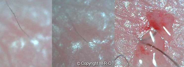 Morgellons topical infection, lesions, swellings