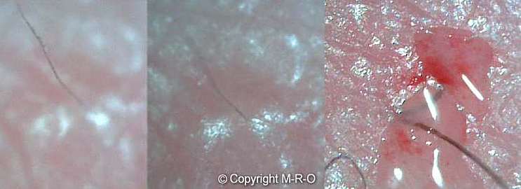 Morgellons-wound.jpg (21395 Byte)