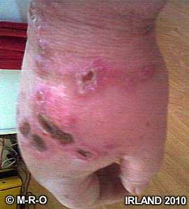 morgellons infection hand