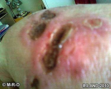 morgellons inflammation