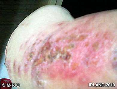 morgellons skin wounds