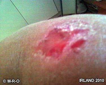 morgellons open wound