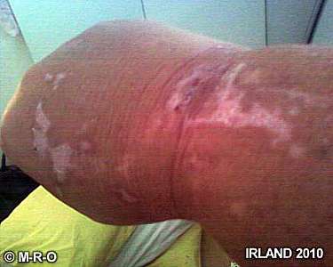morgellons depigmentation spots