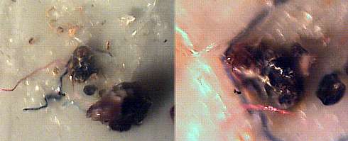 morgellons28.jpg (13645 Byte)