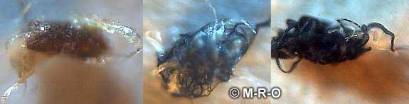 Morgellons black specs fuzzballs