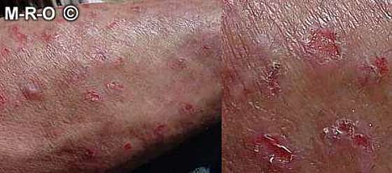 Herpes Virus Gives Man a Blistery Finger Infection