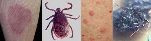 Lyme Ticks and Morgellons