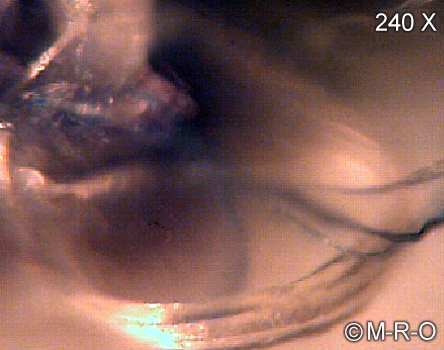 morgellons-fiberbus details