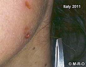 morgellons-filament3.jpg (8758 Byte)