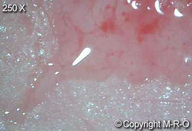 morgellons-infection7.jpg (11096 Byte)