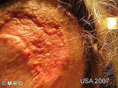 morgellons-lesions