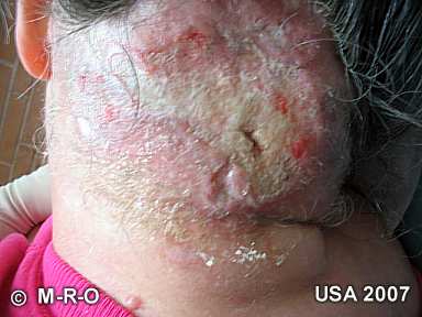 morgellons-lesions