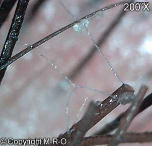Morgellons Fiber loops