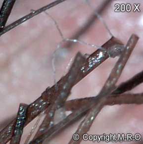 Morgellons Fiber traps