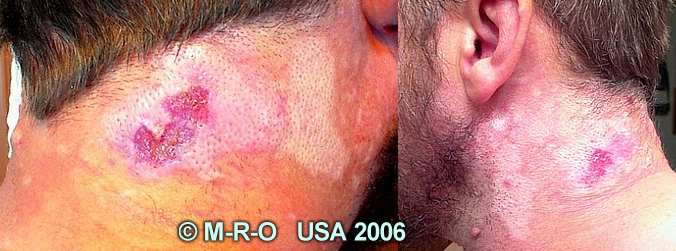http://www.morgellons-research.org/morgellons2/pics/morgellons-wounds1.jpg