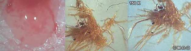 Morgellons Protoplasma und Faserrbündel