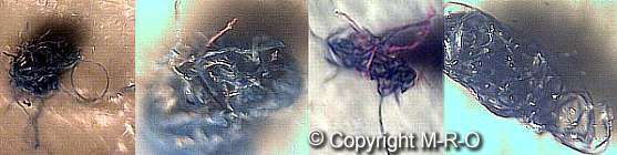 morgellons clothing fibers infestation