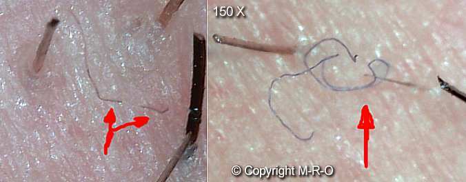 morgellons-infection