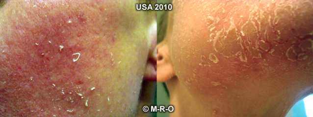 morgellons hyperkeratose