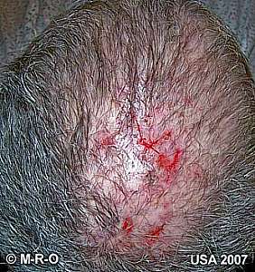 morgellons wunden kopf