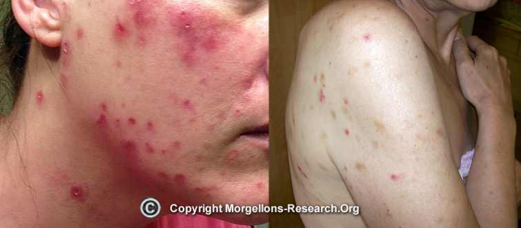 morgellons sores