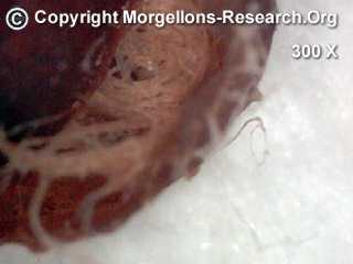 Morgellons Fasern Rhizobium radiobacter3