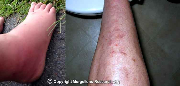 morgellons swollen feet