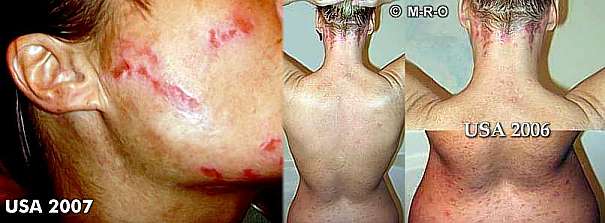 Morgellons Diagnose