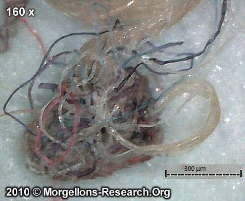 Morgellons Biofilm-Filamentenansammlung