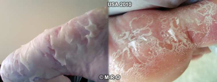 http://www.morgellons-research.org/morgellons2/pics/morgellons-lyme4.jpg