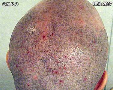 morgellons pusteln