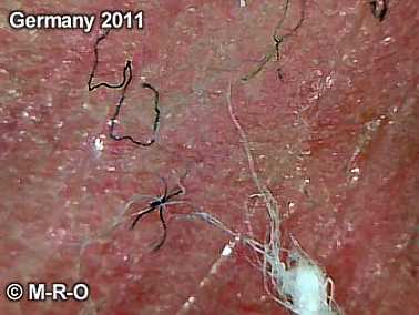 morgellons hautsymptome genitalien