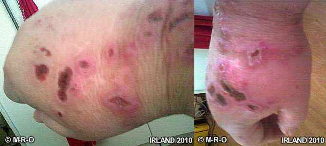 morgellons kratzwunden