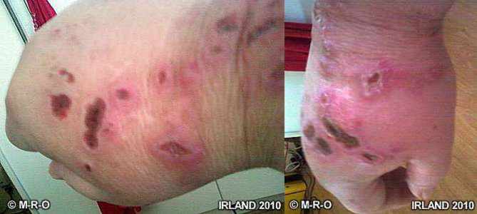 morgellons kratzwunden