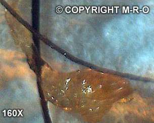 Morgellons Protoplasma